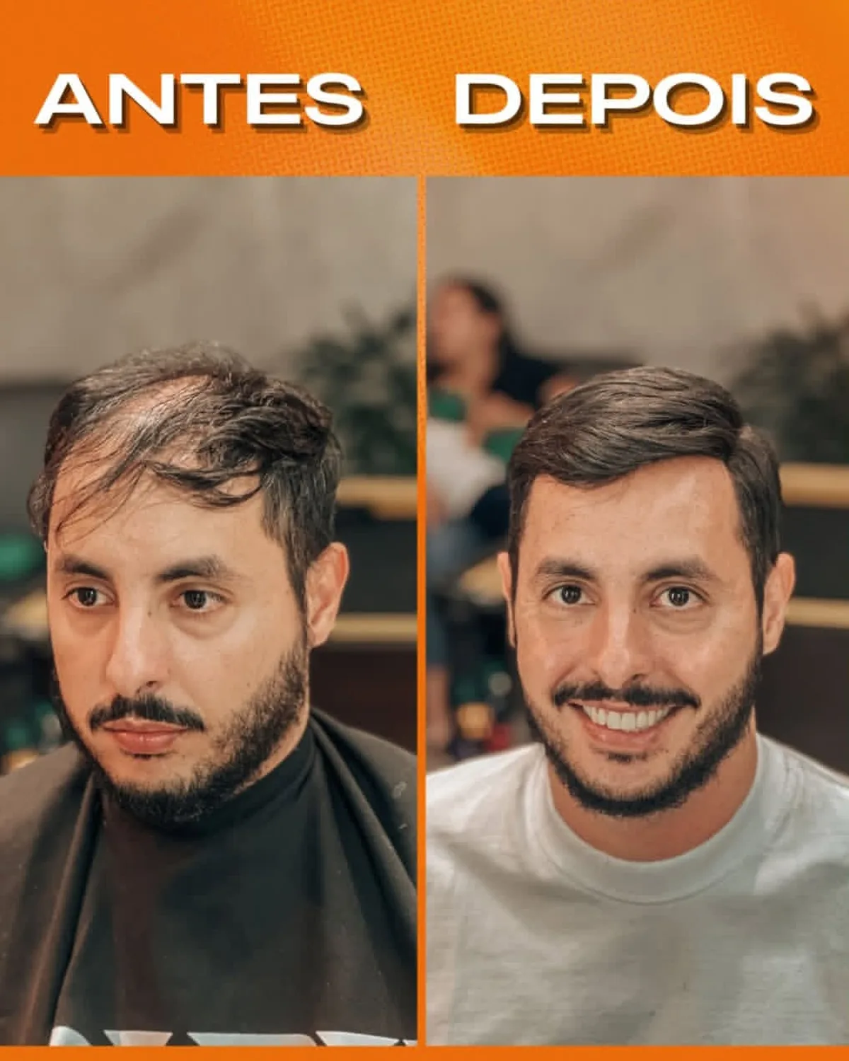 Prótese capilar masculina com resultado natural aplicado na Figaro's Barbearia, Presidente Epitácio