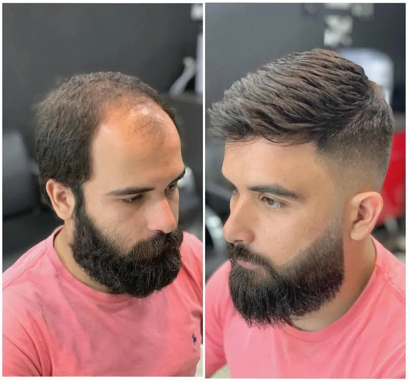 Antes e depois de prótese capilar masculina da Figaro's Barbearia