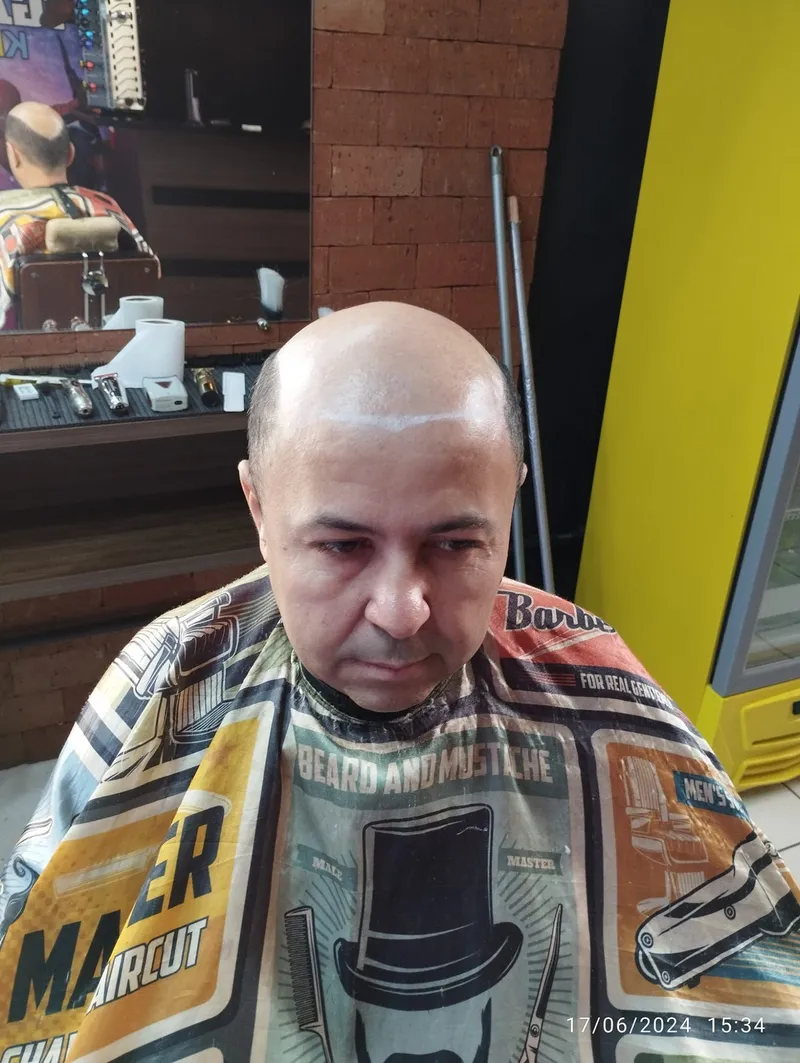 Resultado real de prótese capilar masculina na Figaro's Barbearia, Presidente Epitácio